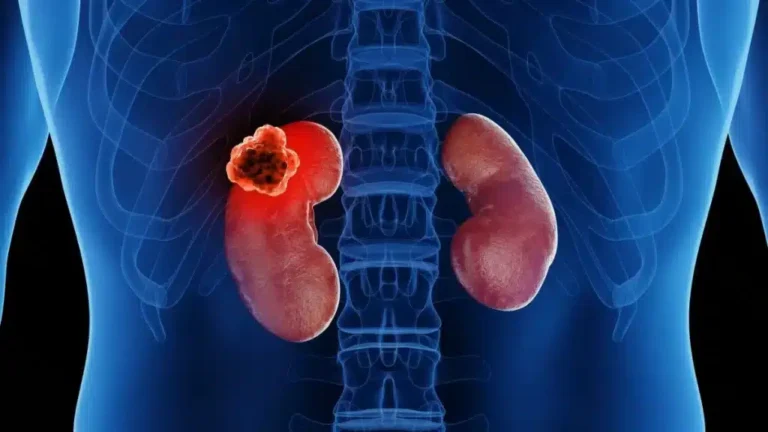 Kidney with cancer